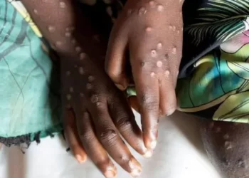 Mpox no es una nueva covid y puede ser contenida, dice la OMS