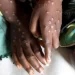 Mpox no es una nueva covid y puede ser contenida, dice la OMS