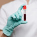 Un análisis de sangre predice el riesgo de enfermedad cardiovascular en las mujeres 30 años antes
