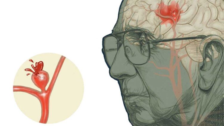 Aneurisma cerebral: una afección más frecuente de lo que se imagina.