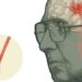 Aneurisma cerebral: una afección más frecuente de lo que se imagina.
