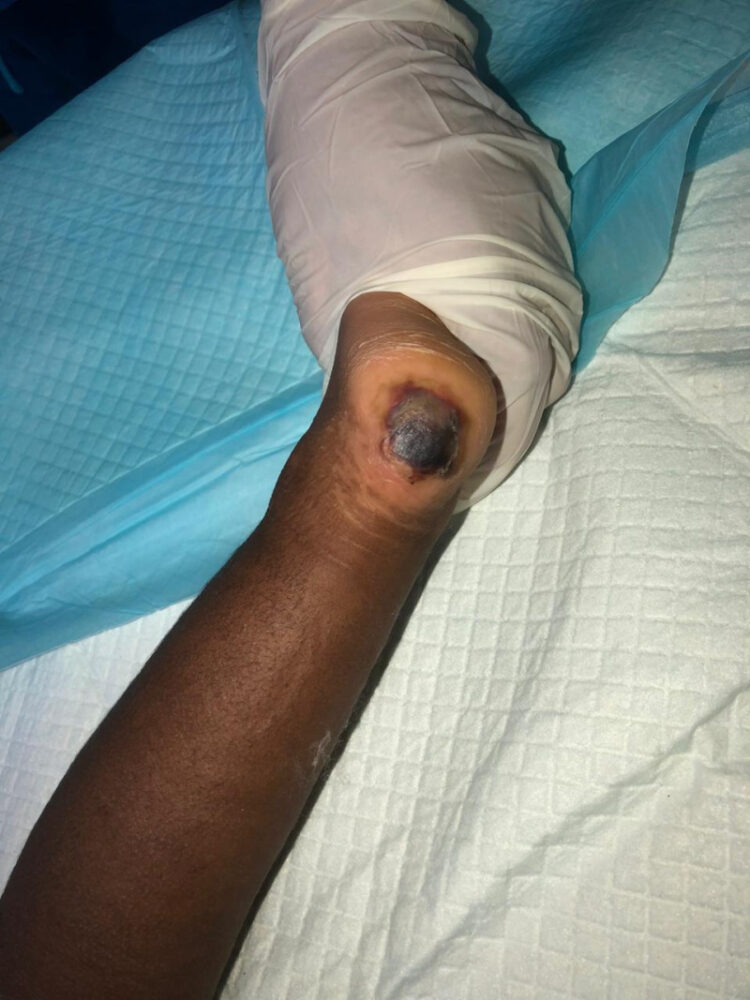 Madre lanza recaudación de fondos para su bebé con celulitis y absceso en sus piernas