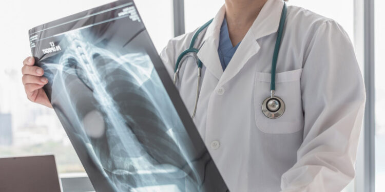 Piden fortalecer el diagnóstico temprano de la hipertensión arterial pulmonar